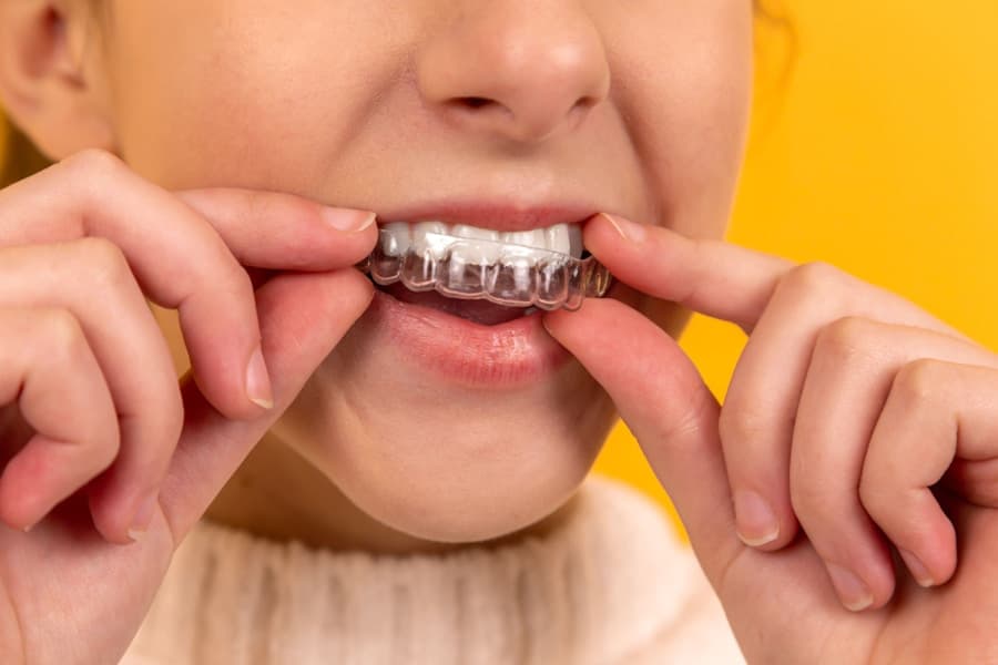 Invisalign Results